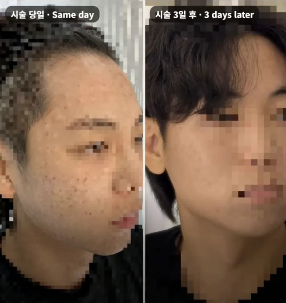 같은 분의 시술 당일과 시술 3일 후 피부 비교 사진, 얼굴은 모자이크 처리