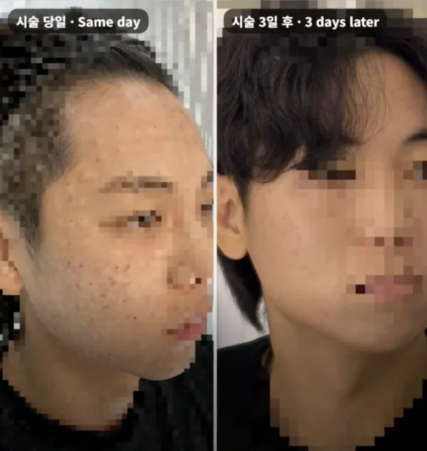 같은 분의 시술 당일과 시술 3일 후 피부 비교 사진, 얼굴은 모자이크 처리